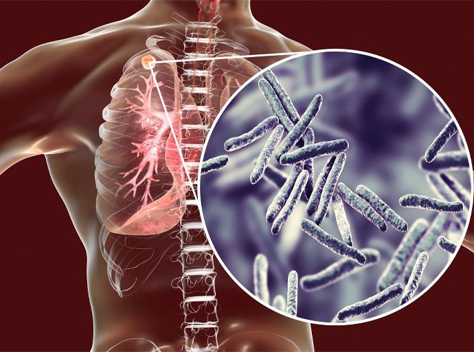 ලෝක ක්ෂය රෝග දිනය; සෞඛ්‍ය නියෝජ්‍ය අමාත්‍යවරයා ඇතුළු නිලධාරීන්ට විශේෂ පලඳනාවක්